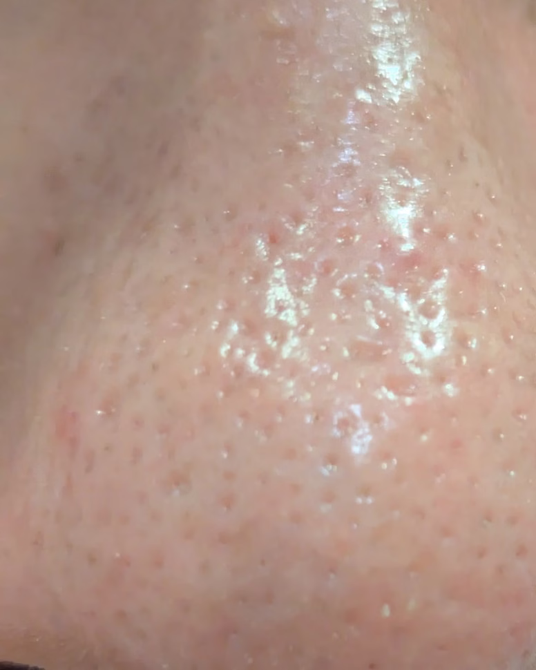 使用後の鼻