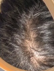 リグロの使用前わっしゃん頭皮